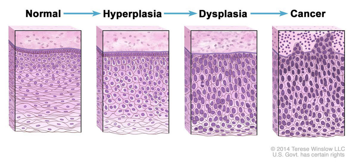hyperplasia-dysplasia-cancer-progression-article