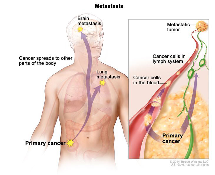 metastasis-enlarge